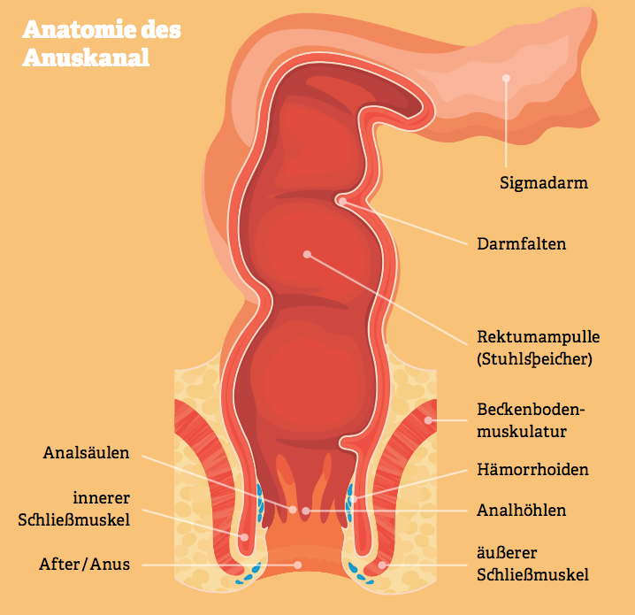 Hämorrhoiden Und Analfisteln Tabuthema Analerkrankungen 3674